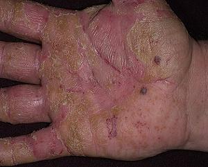 дисгидроз кистей рук фото