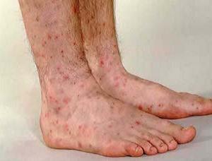 узловатая эритема фото