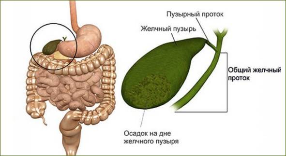 Осадок в желчном пузыре