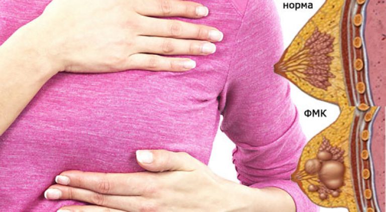 Симптомы мастопатии Симптомы мастопатии