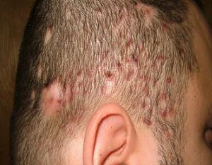 фолликулит волосистой части головы фото