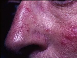 системная красная волчанка фото