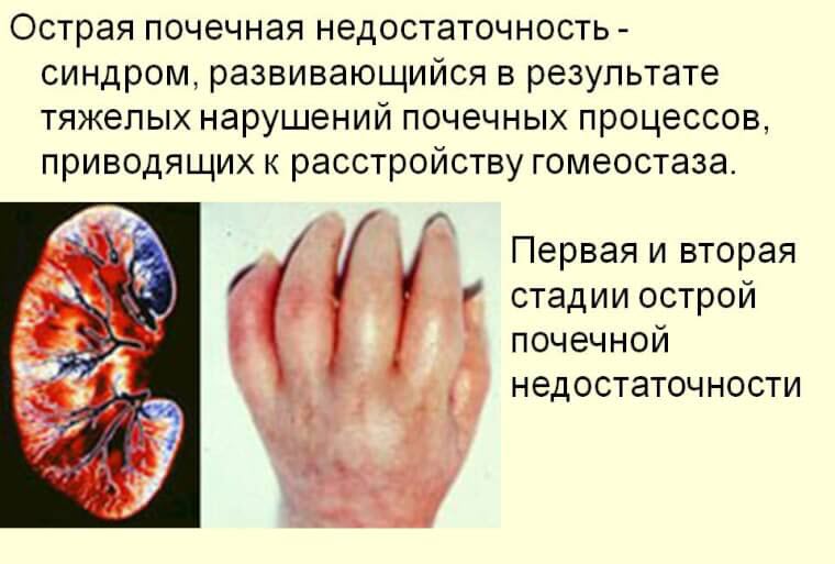 Причины почечной недостаточности