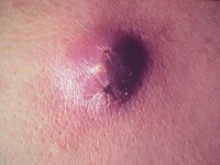 фурункул лечение в домашних условиях