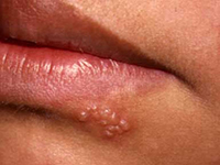 герпес на губах лечение народными средствами