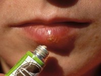 герпес на губах лечение зубной пастой