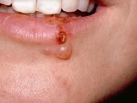 герпес на губах лечение