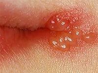 герпес на губах при беременности