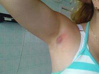 гидраденит под мышкой