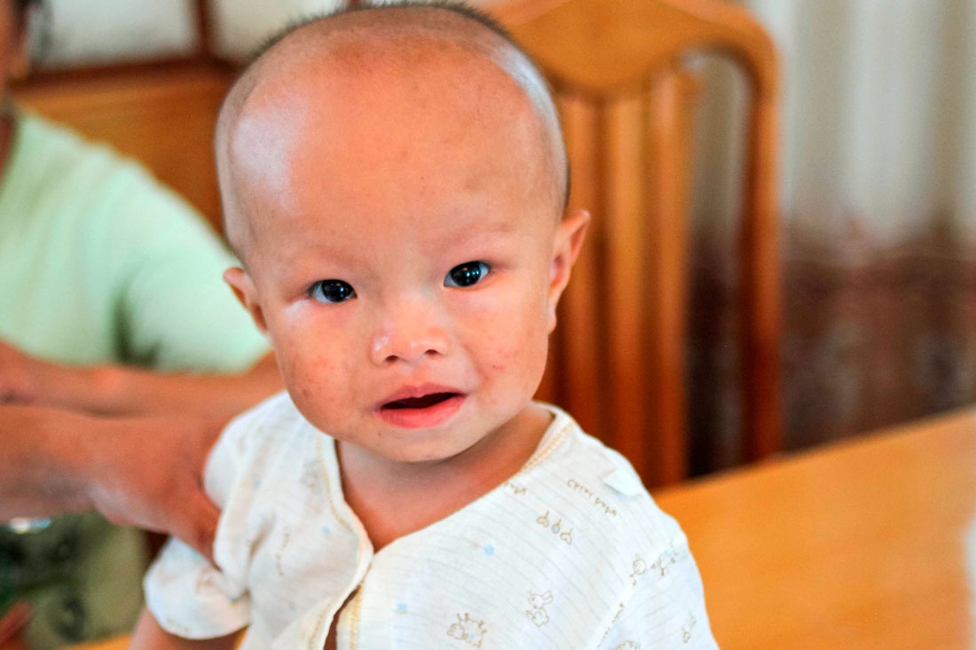 Гидроцефалия