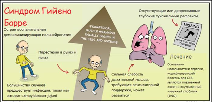 Синдром Гийена-Барре