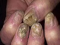 грибок ногтей на руках лечение