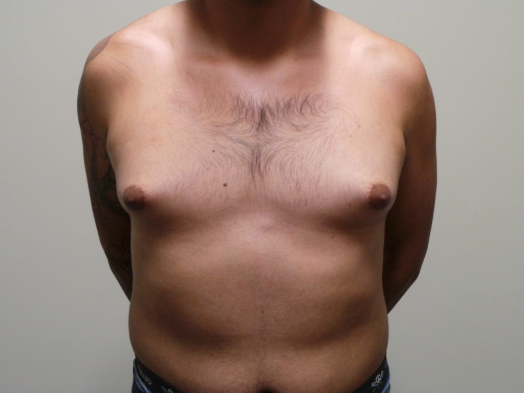 Симптомы гинекомастии