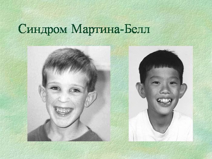 Синдром Мартина Белла
