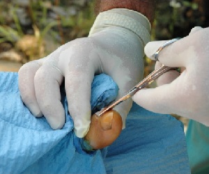 вросший ноготь на ноге фото