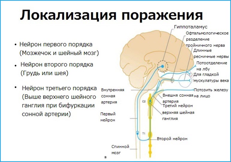 Локализация синдрома Горнера