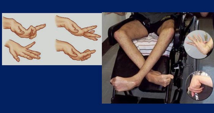 Двусторонний атетоз