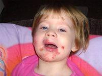 лечение стрептодермии у детей