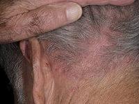 как вылечить себорейный дерматит