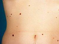 родинки на теле