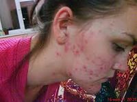 как вылечить демодекоз на лице