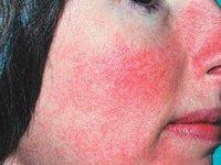 розацеа на лице