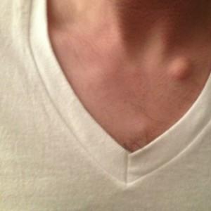 жировики на теле симптомы фото