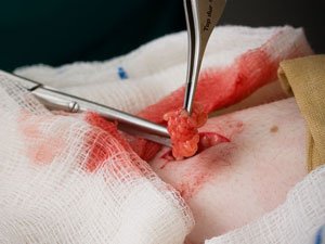 подкожные жировики на теле фото