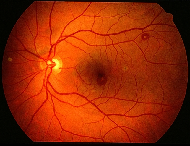 Сосуды глазного дна