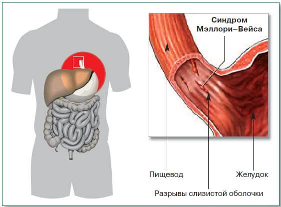 Разрыв слизистой желудка