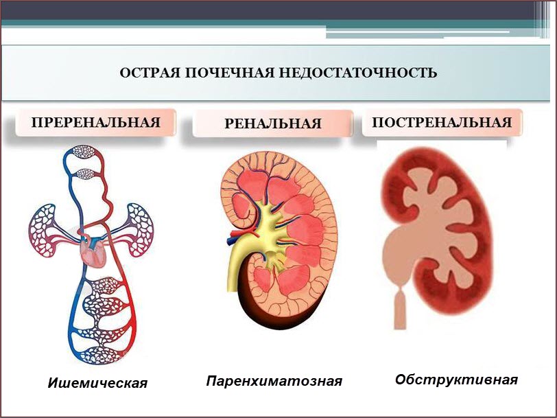 Острая почечная недостаточность