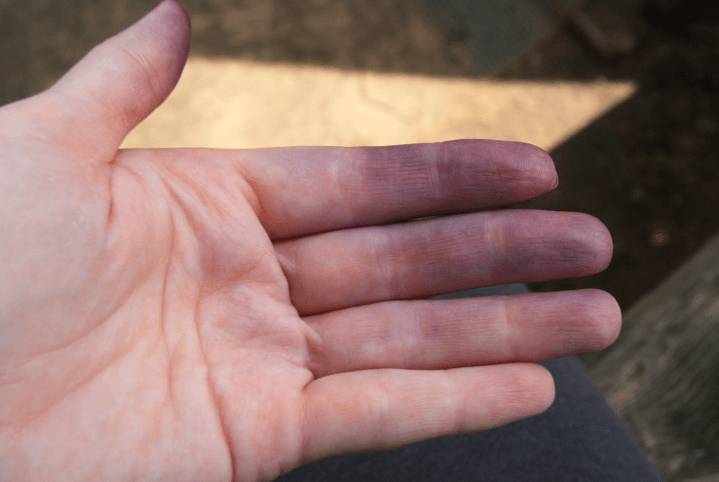 Цианоз верхних конечностей