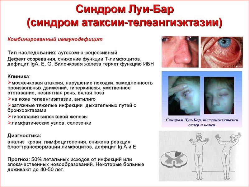 Синдром Луи-Бар