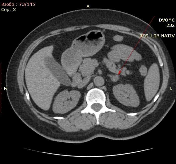 КТ гипофиза
