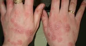сухая экзема на пальцах рук фото