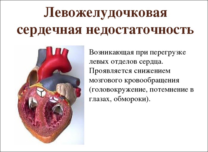 Левожелудочковая сердечная недостаточность