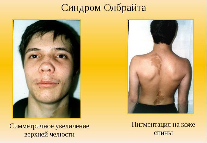 Признаки синдрома Олбрайта