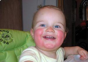 себорейный дерматит фото