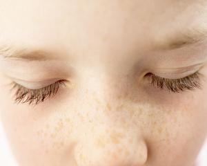 как выглядят пигментные пятна на теле фото