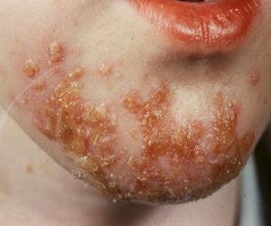 импетиго фото