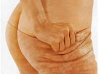 как бороться с целлюлитом