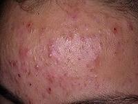 как быстро избавиться от прыщей на лбу