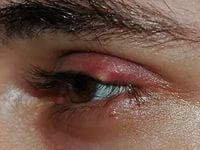 как быстро избавиться от ячменя на глазу