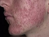 как избавиться от акне