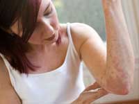 как избавиться от аллергии народными средствами