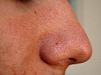 как избавиться от черных точек