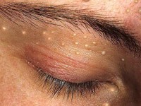 как избавиться от милиумов