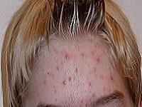 как избавиться от прыщей на лбу