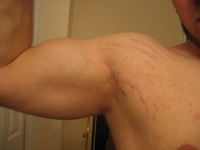 как избавиться от растяжек на теле