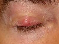как избавиться от ячменя на глазу